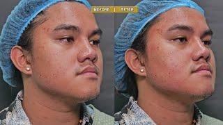 Male face lifting and reshaping with cog threads , and acne scar treatment with Eladerm