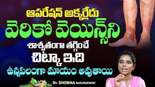 #VaricoseVeins Treatment | Health Tips in Telugu | Relief from Nerve Swelling | Hi Tv Telugu