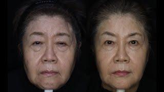 70대 실 리프팅 후 리터치까지 한다면 결과가 얼마나 오래갈까? 실시간 리얼 리터치 리프팅 과정 전부 공개