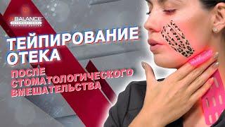  ТЕЙПИРОВАНИЕ ОТЕКА ПОСЛЕ СТОМАТОЛОГИЧЕСКОГО ВМЕШАТЕЛЬСТВА | Сания Абдрахманова | BBALANCE