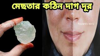 এটি ১ বার মুখের ত্বকে লাগিয়ে দেখুন,কঠিন মেছতা দূর/মেছতা দূর করার ঘরোয়া দুটি উপায়