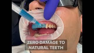 See it to believe it! Completely non-cutting veneers by Dr Aleem. Zero Damage to Natural teeth!