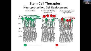 Regeneration and stem cell transplantation as treatment for optic neuropathies