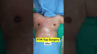 FTM  Top Surgery #dezireclinicindia #plasticsurgery