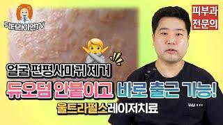 얼굴 편평사마귀 제거 듀오덤 안 붙이고 바로 출근 가능한 울트라펄스레이저치료