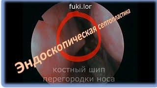 Эндоскопическая септопластика: удаление костного шипа. ЛОР-хирург к.м.н. Фуки Евгений Михайлович