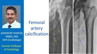 Femoral artery calcification