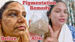 6 years of Pigmentation |  Best Remedy for Pigmentation