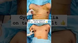 Gynecomastia Surgery  Results at Kyra Aesthetic Clinic | Dr Vikas Gawri|