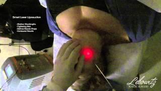 Neck Lift / Laser Smart Lipo Huntington, Long Island NY by Dr. Lebowitz