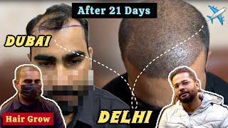 Dubai Hair Transplant Patient Result after 21 Days #hairtransplantresult