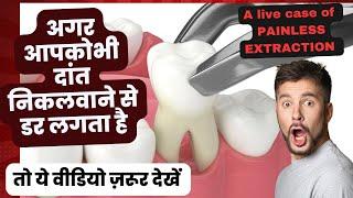 अगर आपको भी दांत निकलवाने से डर लगता है तो यह वीडियो जरूर देखें-Painless tooth extraction -LIVE