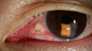 How to Remove a Hidden Eyelash from The Eye.