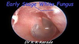 Early Stage Fungus Encountered  After Endoscopic Earwax Removal