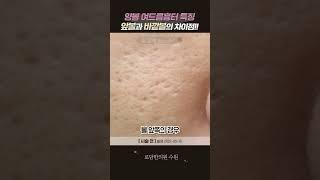#여드름흉터 #여드름흉터치료 #볼여드름흉터 #여드름자국 #아이스픽 #박스카 #롤링 #여드름흉터제거 #shorts