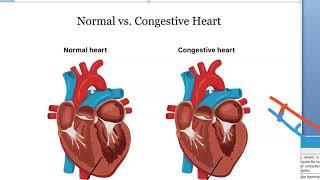 Medicine 485 a Heart failure Define what is CAUSES Cardiac Congestive CCF definition