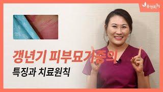 중년여성에게 나타나는 피부 화끈거림, 벌레기어가는 느낌, 가려움 – 피부묘기증 or 갱년기증후군?