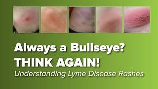 Think the Lyme Disease Rash is Always a Bull's-eye? Think Again!  | Johns Hopkins Rheumatology