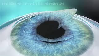 Лазерная коррекция зрения Femto-LASIK