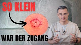 Talgzyste am Rücken entfernen: Dr. Kasten Hautmedizin in Mainz epidermal cyst removal Dana procedure