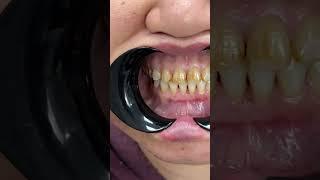 Реставрация Зубов #кыргызстан #бишкек