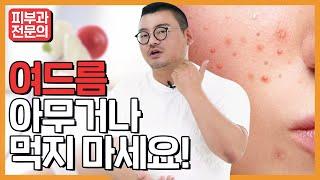 여드름 없애는 방법! '이 음식'을 주목하세요 (여드름에 좋은음식 VS 나쁜음식)