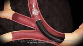 Endobronchial Valve Animation - SPIRATION