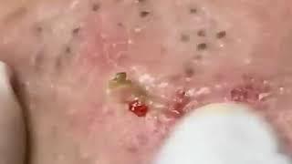 Blackheads Removal OMG Video | Acne Clear (29)