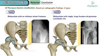 Dislocation Of Hip: Orthopedics Lecture