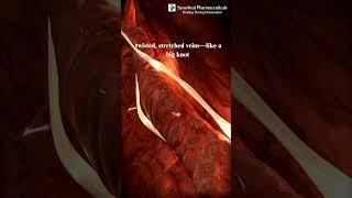 Got twisted, bulging veins?