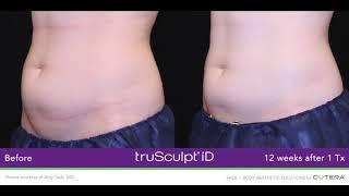 truSculpt iD Non-Invasive Fat Reduction | Advanced Specialty Care's Virtual Cosmetic Open House