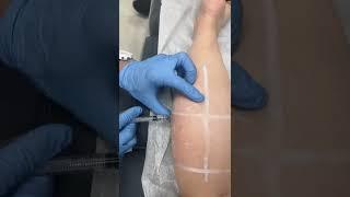 Calf Muscles Sliming Treatment - Ageless MD of Dr. Tsay