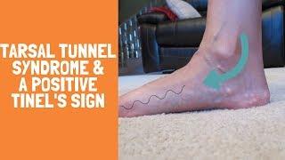 Tarsal Tunnel Syndrome with a Positive Tinel's Sign