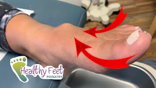 LARGEST CYST IN FOOT DOCTOR HAS EVER SEEN