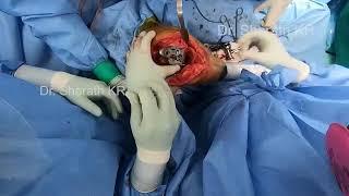 Total knee replacement for Ankylosed knee in 40 deg flexion - Dr Sharath K R , Bangalore