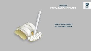 Временный цементный имплантат коленного сустава Spacer K