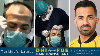 Wahab Riaz Cricketer Hair Transplant by Dr. Nasir Rashid at Hair Club In Pakistan