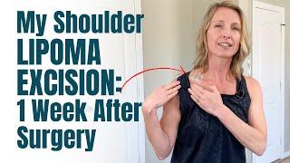 My Shoulder Lipoma Removal: 1 Week Post Surgery