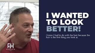 Hair Transplant Review - Forhair's Patient - February 2019