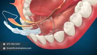 Orthodontic Procedures - Minor Tooth Movement