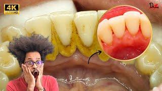 ASMR How Dentist cleans your teeth #Satisfying