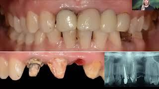 Alternative treatment approach for anterior subgingival dental lesions: Forced eruption using attrac