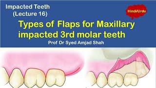 Types of flaps for Maxillary Impacted Third Molar | Oral & Maxillofacial Surgery | Syed Amjad Shah