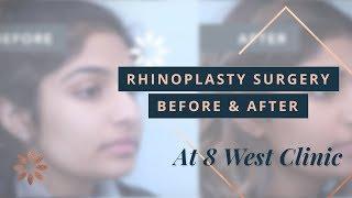 Rhinoplasty Transformations at 8 West Clinic in British Columbia - Before & After | Dr. Buonassisi