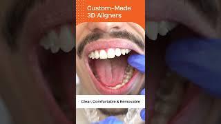 How the Clear Aligners works | Clear Moves Aligners