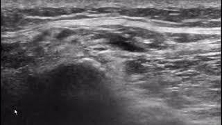 Ultrasonographic Technique for Imaging and Injecting the Superior Cluneal Nerve