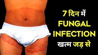 Aise Karao 7 Din Me Fungal Infection Khatam #medifact #shorts #shortsfeed