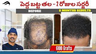 Hair Transplant In Hyderabad | Best Results  Cost & Center Of Hair Transplant Surgery In Hyderabad