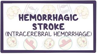 Hemorrhagic stroke: intracerebral hemorrhage - causes, symptoms, diagnosis, treatment, pathology