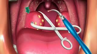 Animation Surgery of Tonsillectomy & Adenoids